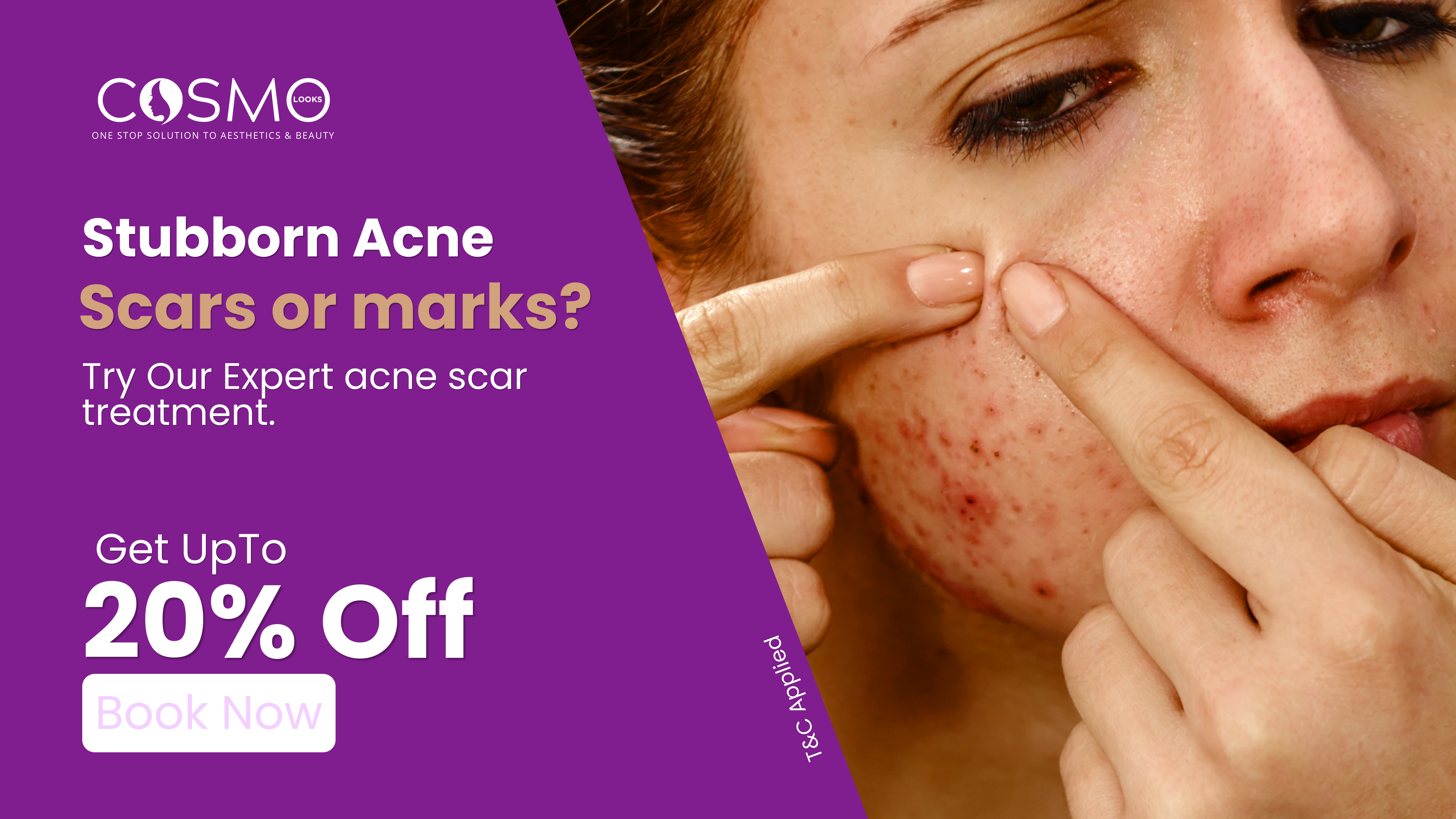 Stubborn Acne — 20% Off — Book Now